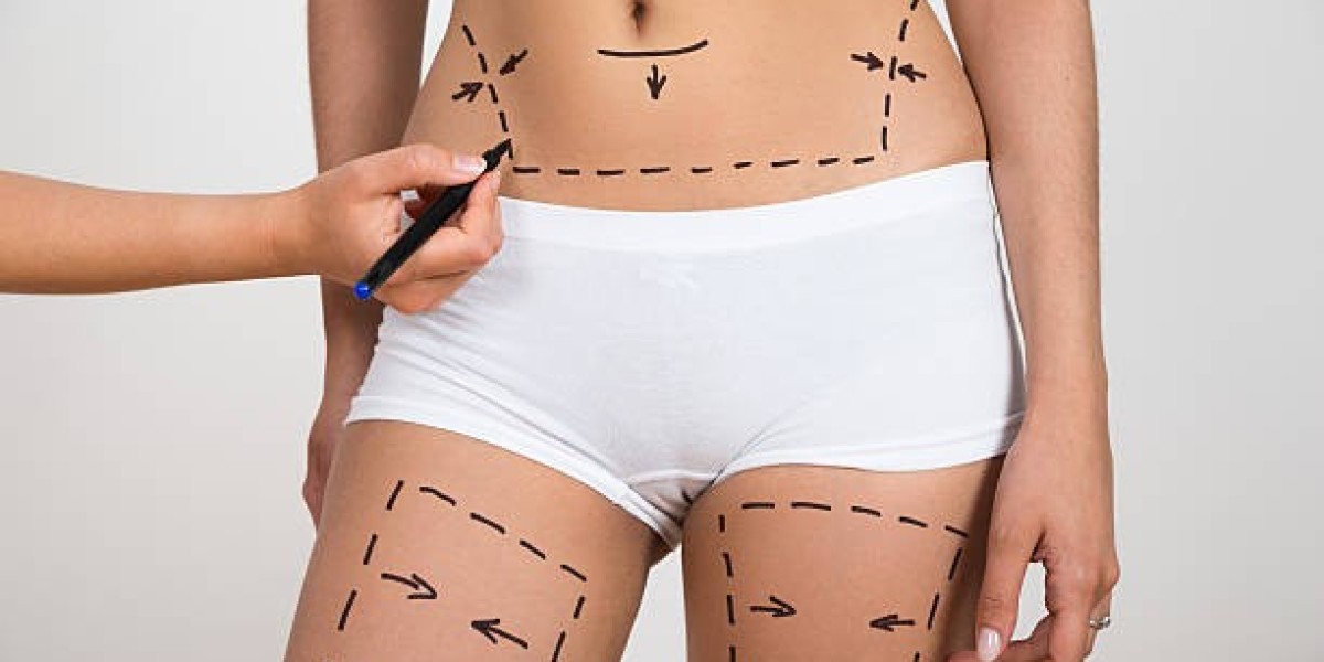 Who Is a Good Candidate for Liposuction?