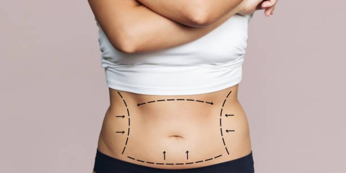 Liposuction in Riyadh for Women: Understanding Body Contouring