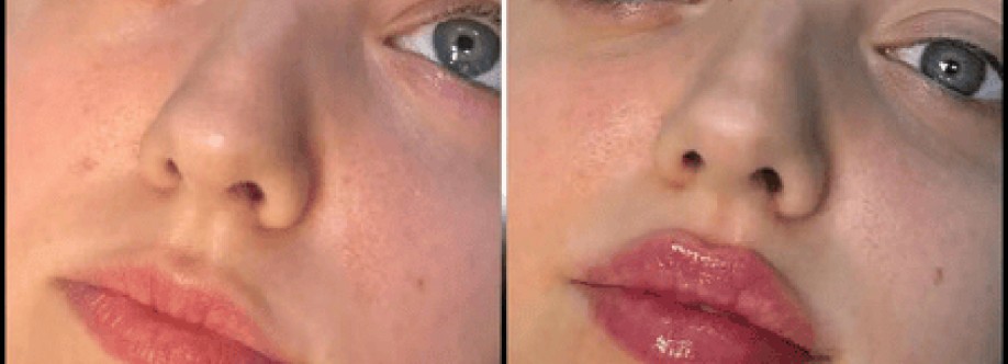 dermal fillers Cover Image