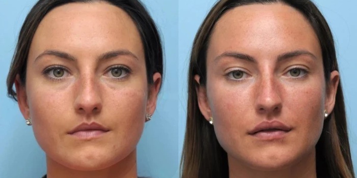 Best Doctors in Dubai for a Refreshed Appearance Through Thread Lift