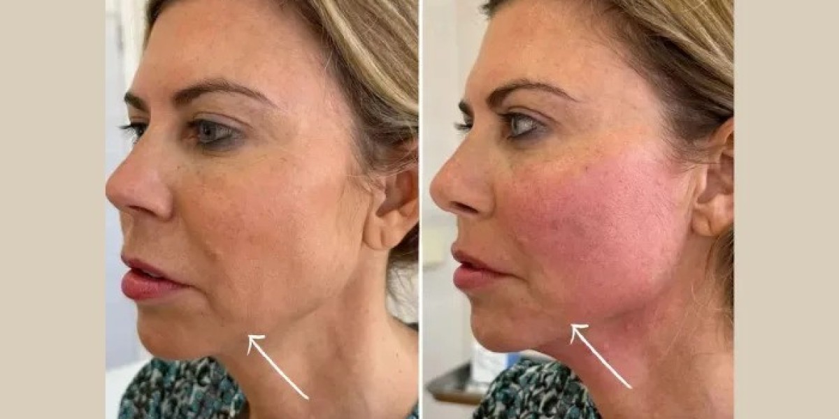 Best Doctors in dubai for Endolift Treatments for Facial Definition