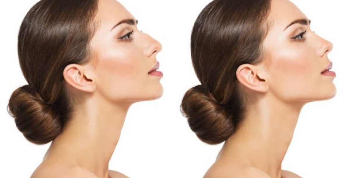 How Long Does Rhinoplasty Swelling Usually Last?