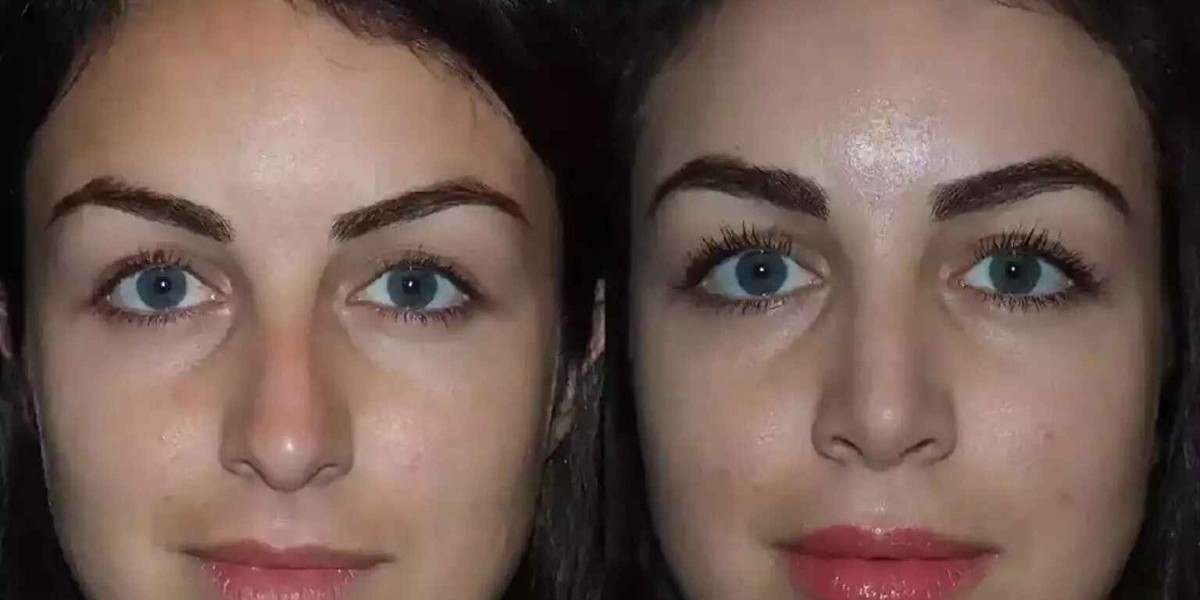 How Do the Best Septoplasty Surgeons in Dubai Monitor Healing Progress?