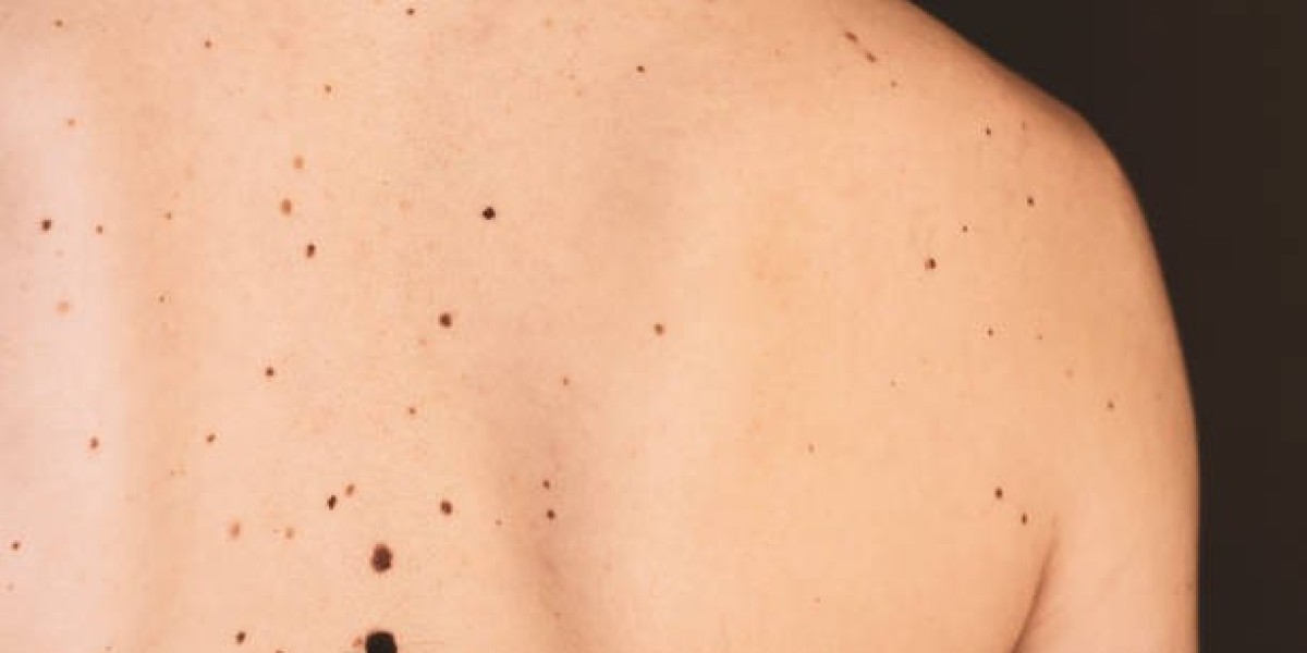 Mole Removal Treatment Guide for Common Types of Skin Moles