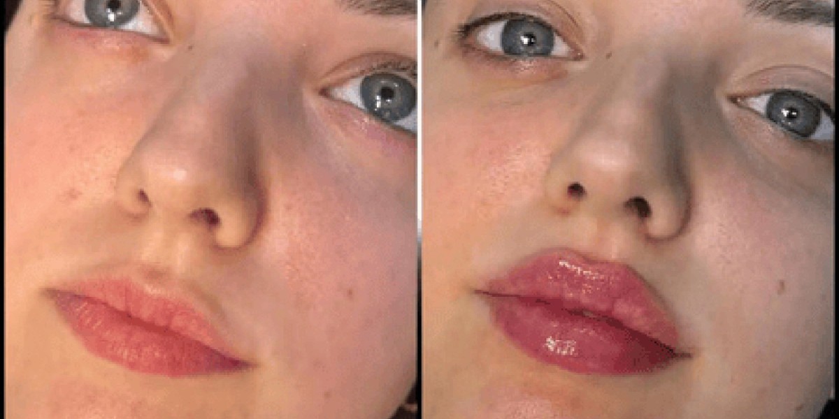 Best Doctors in dubai for Fillers: Ranked by Experience