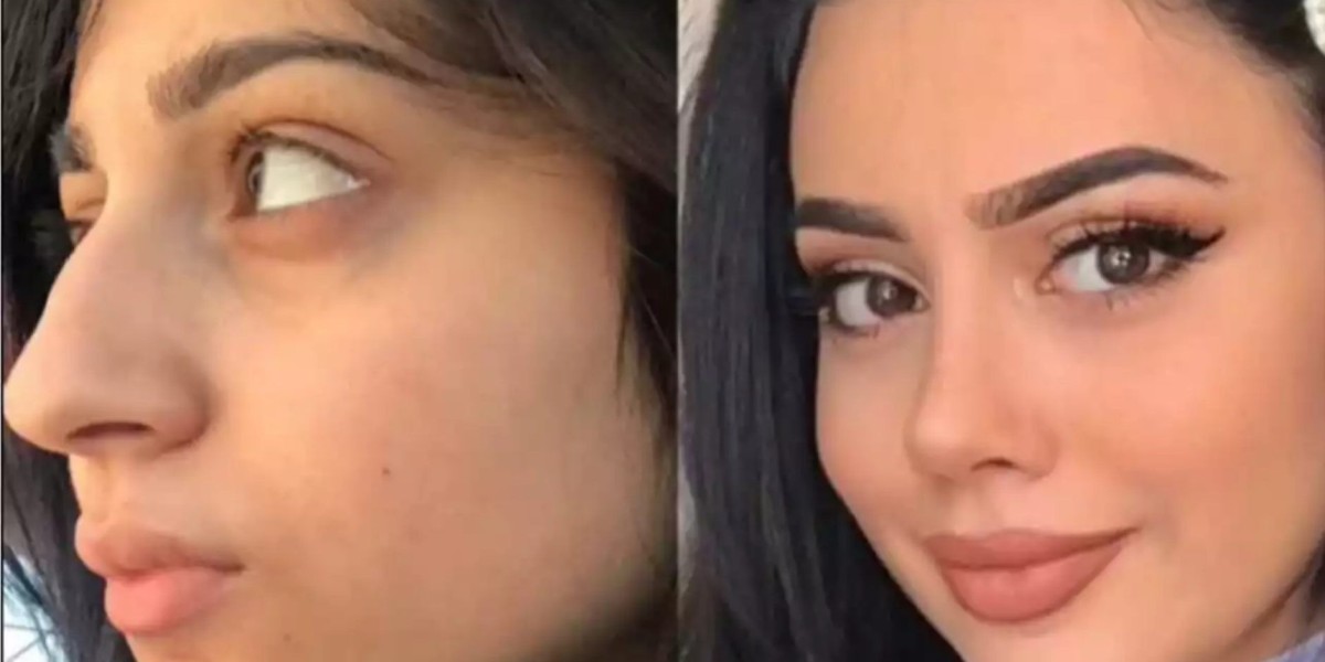 How Do the Best Rhinoplasty Surgeons in Dubai Support Healing?